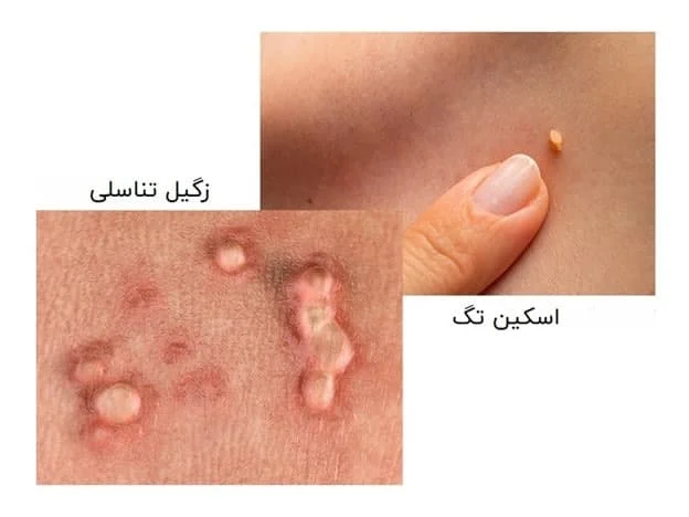 زگیل تناسلی