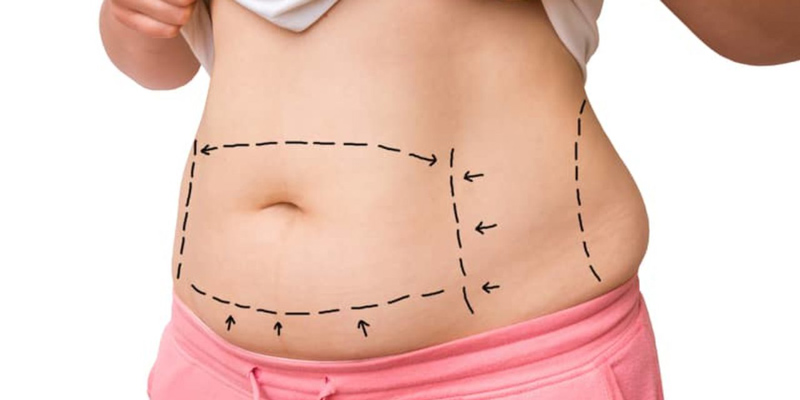 Side effects of removing belly fat with laser