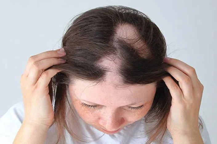 سلامت و دانش Coin hair loss Treatment of baldness in men and women