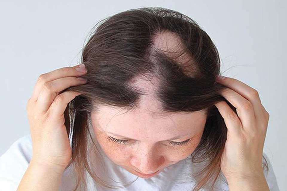 Coin hair loss Treatment of baldness in men and women