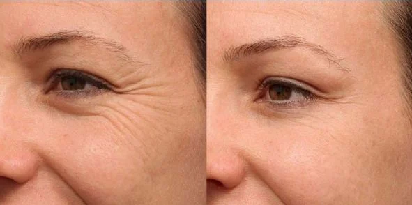How to inject Botox around the eyes