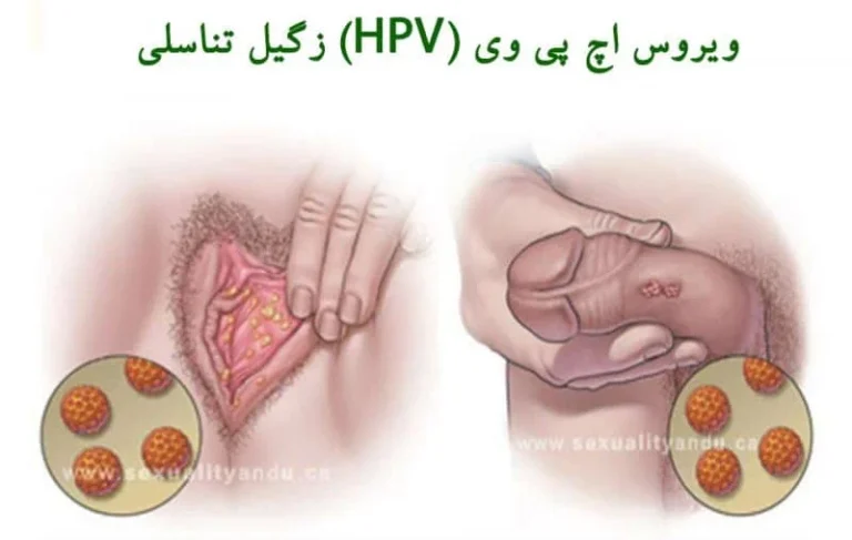 زگیل تناسلی چیست؟