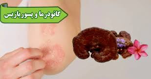 بیماری |گانودرما بیماری |گانودرما