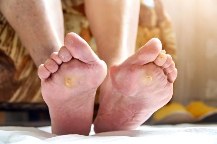 علائم پوستی که نباید نادیده گرفته شوند؛ نشانه‌ های احتمالی دیابت