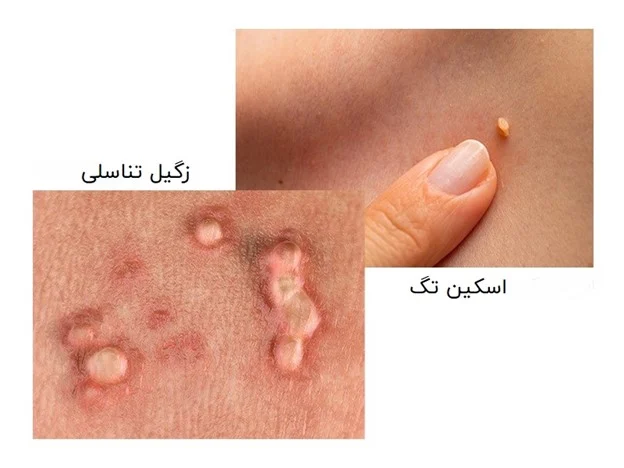 زگیل |زگیل تناسلی زگیل |زگیل تناسلی